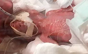 After Spending Months In The Hospital, The World's Smallest Surviving Premature Baby Has Been Finally Sent Home