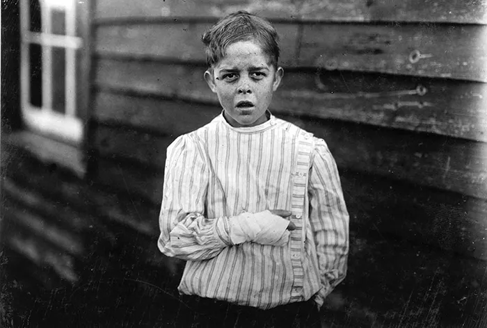 An Injured Young Mill Worker