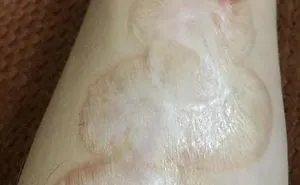 Hide Scar By Tatto