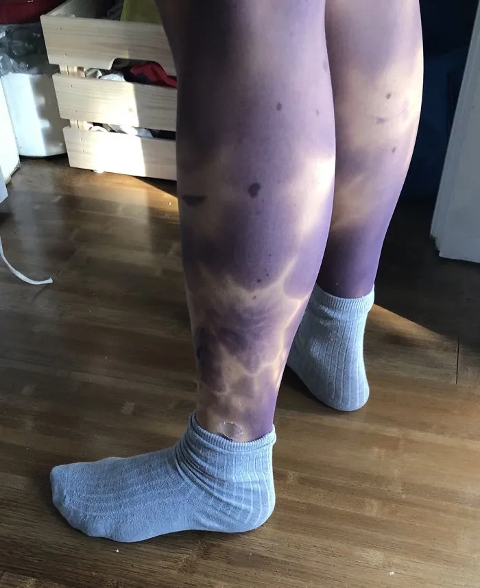Estas medias te hacen parecer que tus piernas tienen moratones