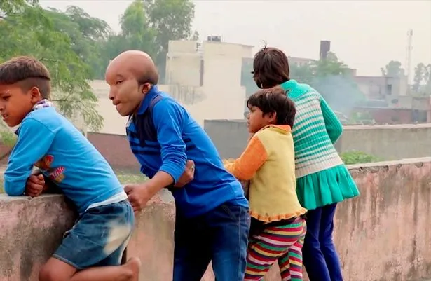 Dubbed As “Alien”, Man With Enlarged Head Disorder Wants Surgery So He Can Find Love