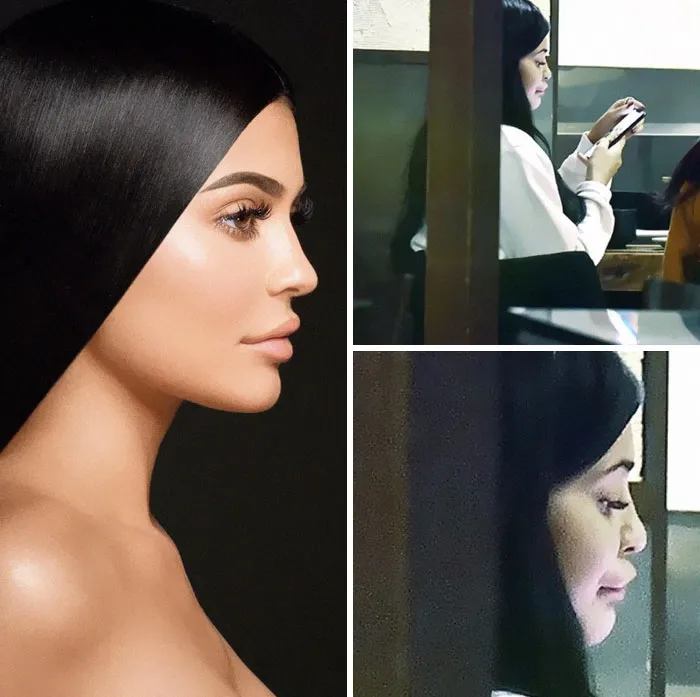 Lips Fillers Insta vs. Paparazzi