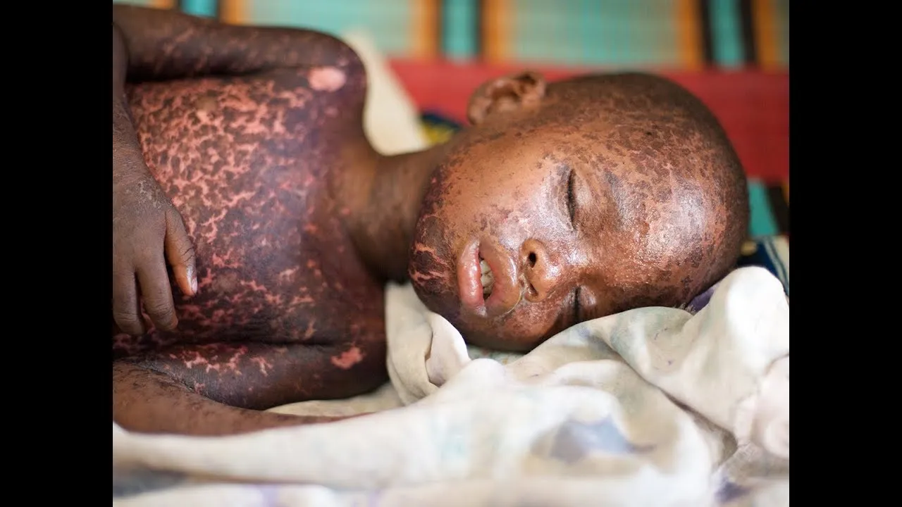 If You Were Born Between These Years, You May Be Susceptible To This Potentially Deadly Disease