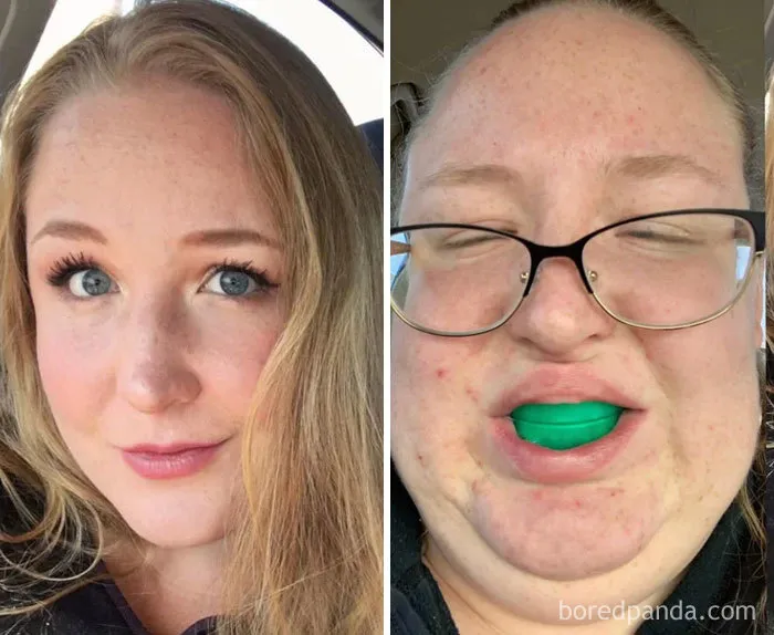They Said Whitening My Teeth Would Make Me Prettier