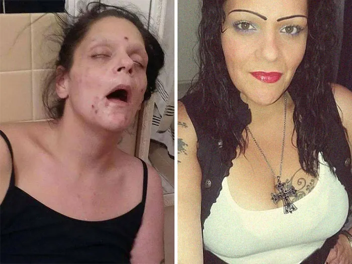 I Have Been In Recovery For A Year And A Half