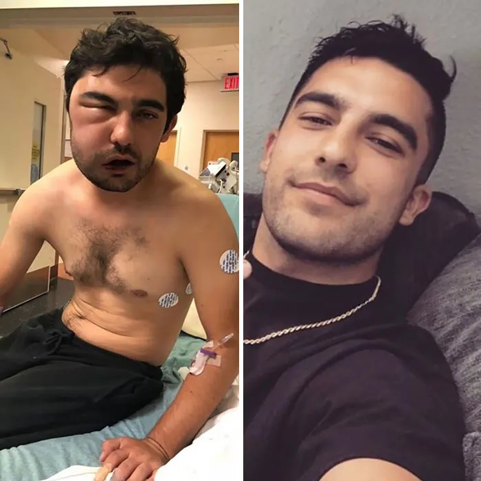Hace 8 meses tuve una sobredosis y el médico no sabe cómo sobreviví