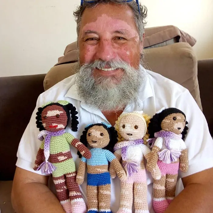 This Grandfather With Vitiligo Crochets Dolls For Children With The Condition