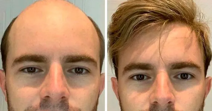 Balding Guys Try Out Non-Surgical Hair Replacements By Phil Ring, And Their Smiles Say Everything (44 Pics)