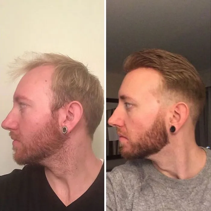 Balding Guys Try Out Non-Surgical Hair Replacements By Phil Ring, And Their Smiles Say Everything (44 Pics)