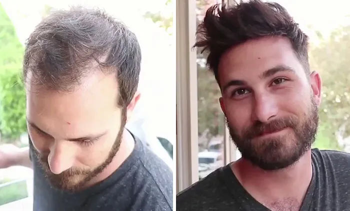 Balding Guys Try Out Non-Surgical Hair Replacements By Phil Ring, And Their Smiles Say Everything (44 Pics)