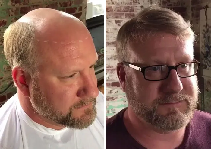 Balding Guys Try Out Non-Surgical Hair Replacements By Phil Ring, And Their Smiles Say Everything (44 Pics)