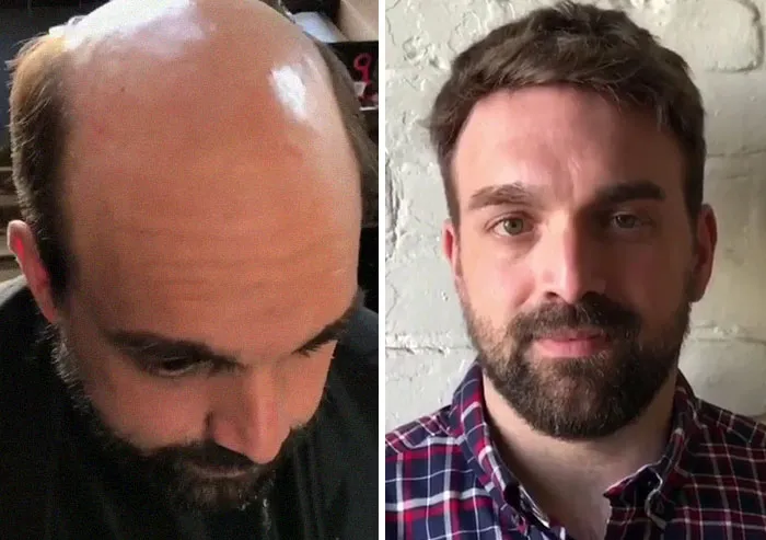Balding Guys Try Out Non-Surgical Hair Replacements By Phil Ring, And Their Smiles Say Everything (44 Pics)