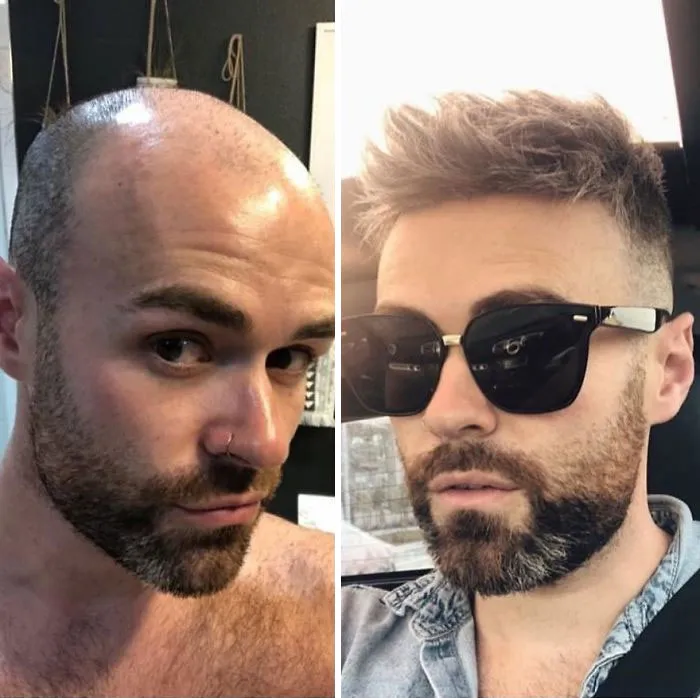 Balding Guys Try Out Non-Surgical Hair Replacements By Phil Ring, And Their Smiles Say Everything (44 Pics)