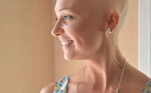 I'm Shedding Some Truth On Female Baldness: It's Not Always Cancer
