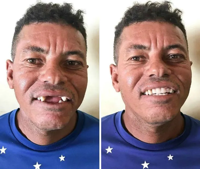 Un Dentista De Brasil Viaja Para Arreglar Gratis La Dentadura De Los Pobres