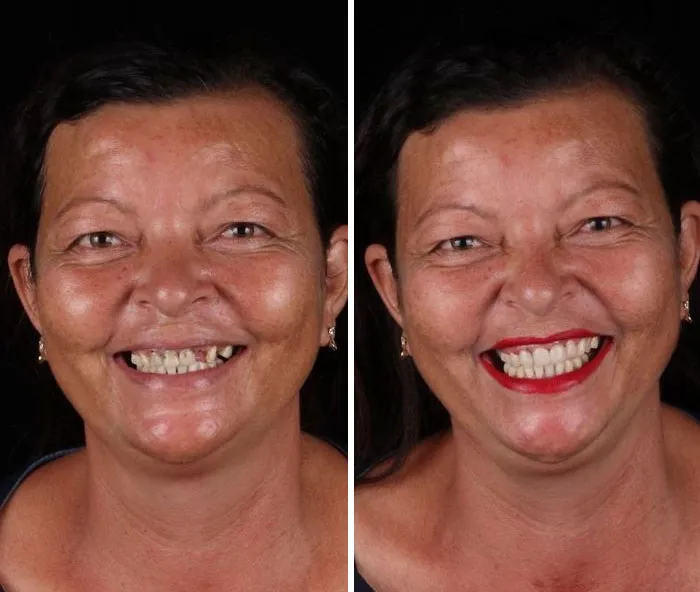 Un Dentista De Brasil Viaja Para Arreglar Gratis La Dentadura De Los Pobres