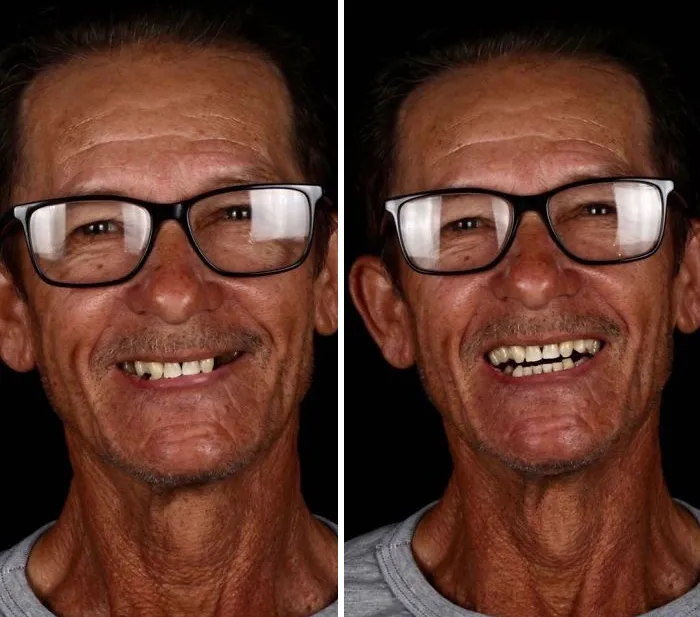 Un Dentista De Brasil Viaja Para Arreglar Gratis La Dentadura De Los Pobres