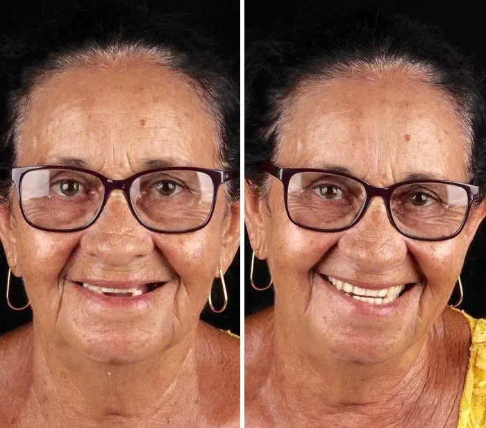 Brazilian Dentist Travels To Treat The Teeth Of Poor People For Free And Here Are 30 Transformations
