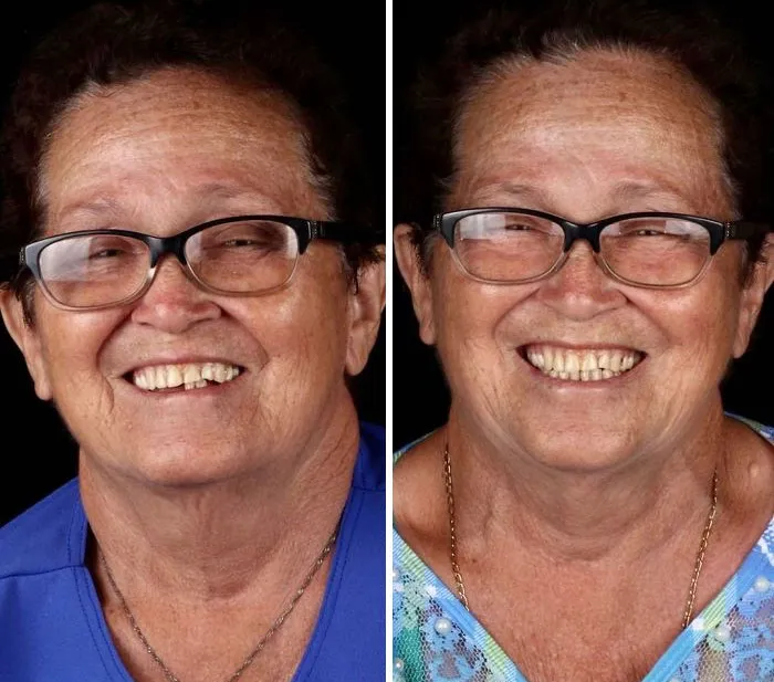 Brazilian Dentist Travels To Treat The Teeth Of Poor People For Free And Here Are 30 Transformations