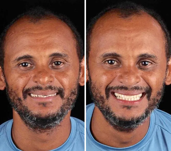 Brazilian Dentist Travels To Treat The Teeth Of Poor People For Free And Here Are 30 Transformations