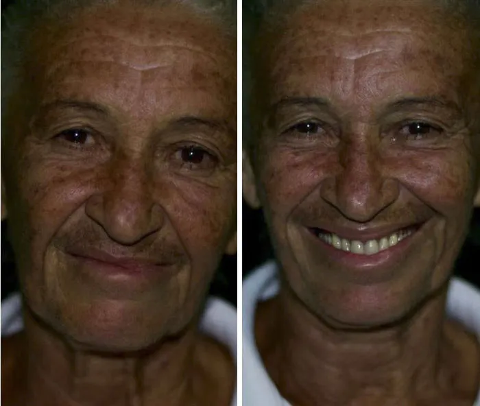 Brazilian Dentist Travels To Treat The Teeth Of Poor People For Free And Here Are 30 Transformations
