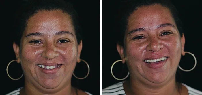Un Dentista De Brasil Viaja Para Arreglar Gratis La Dentadura De Los Pobres