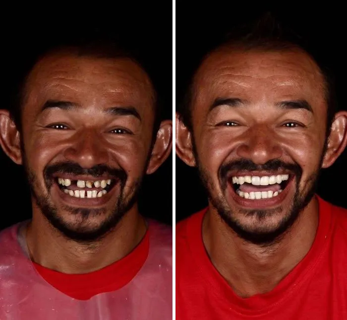 Un Dentista De Brasil Viaja Para Arreglar Gratis La Dentadura De Los Pobres