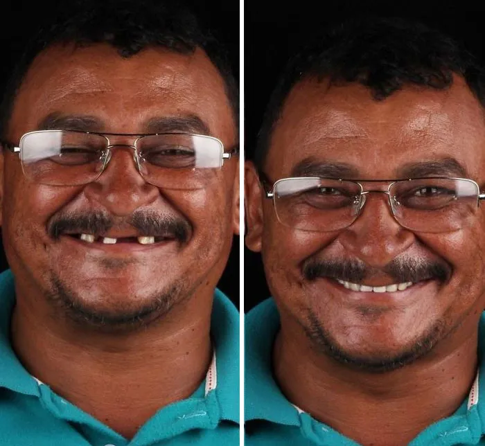 Un Dentista De Brasil Viaja Para Arreglar Gratis La Dentadura De Los Pobres
