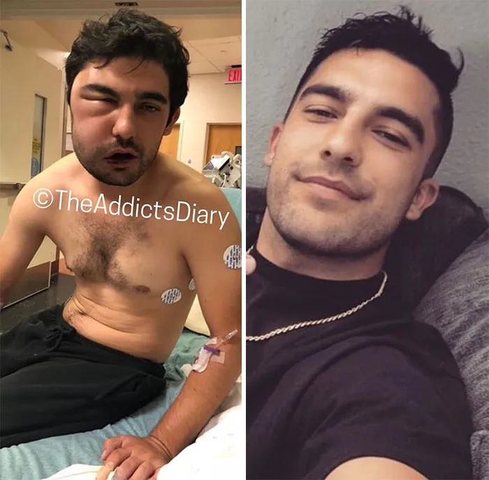 'The Addict's Diary' Showcases Before & After Transformations Of People Who Quit Drugs (30 Stories)