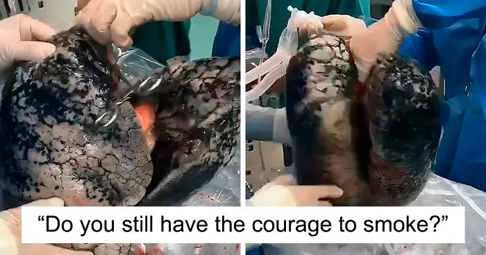 Surgeons Show What The Human Lungs Look Like After 30 Years Of Smoking & It's Shocking
