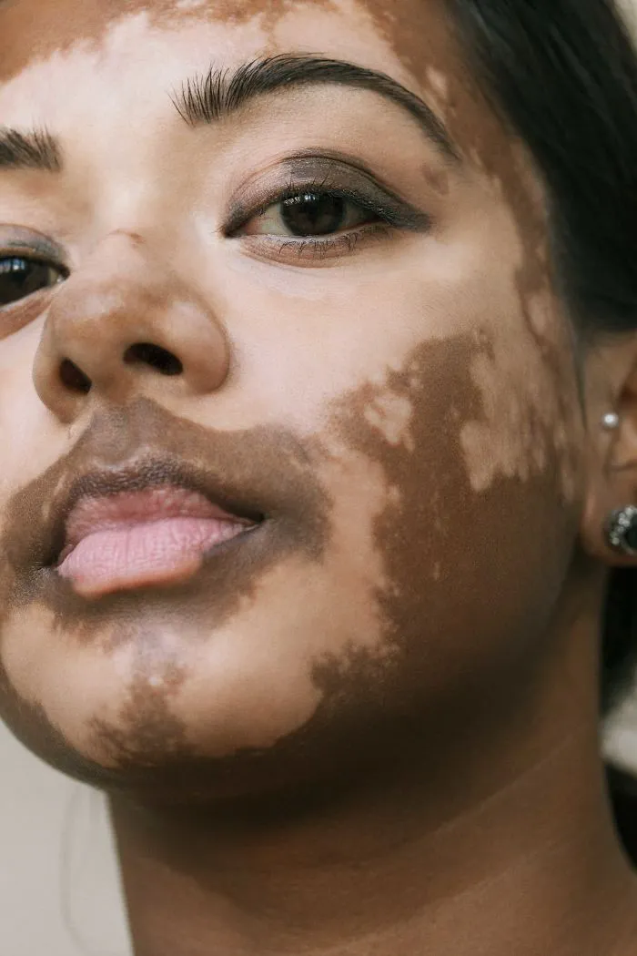 35 Beautiful Women With Vitiligo Shot By A Photographer Who Has The Same Condition