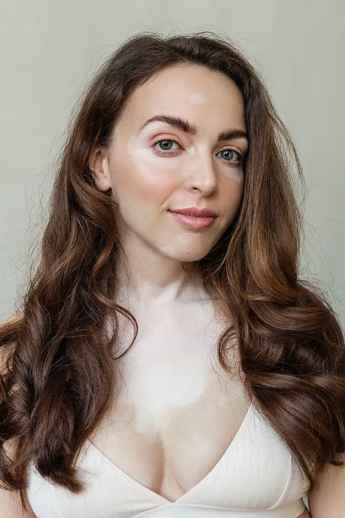 35 Beautiful Women With Vitiligo Shot By A Photographer Who Has The Same Condition