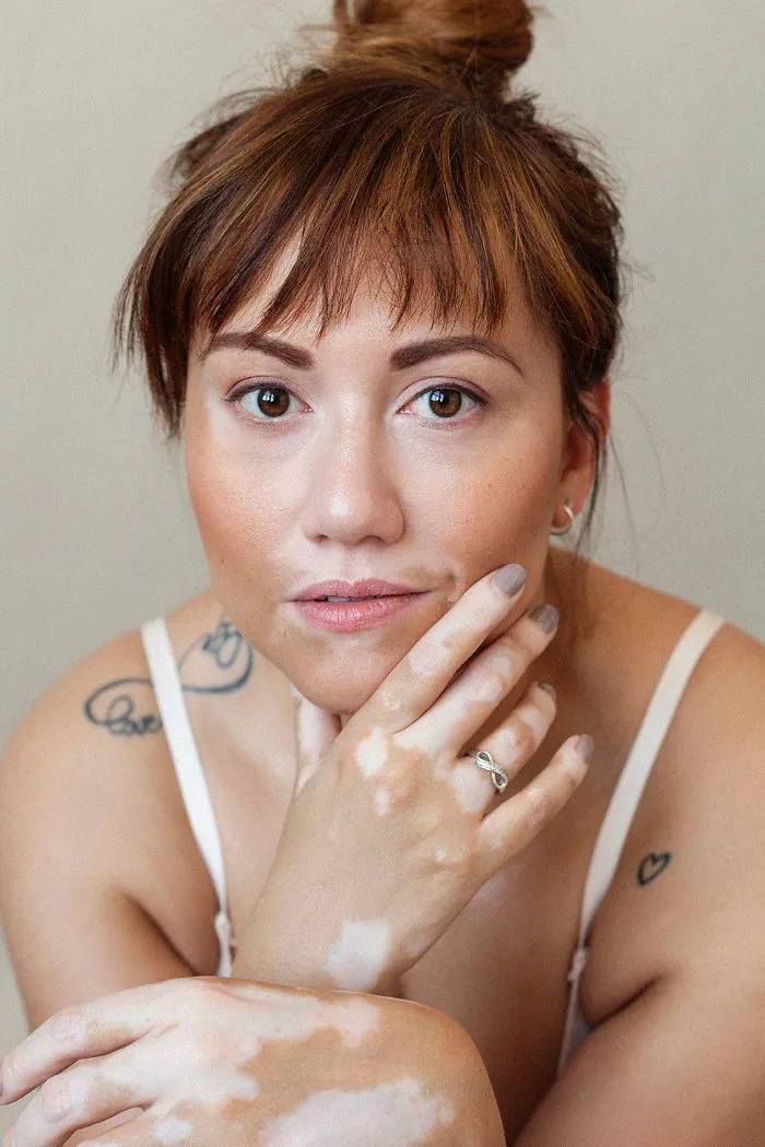 35 Beautiful Women With Vitiligo Shot By A Photographer Who Has The Same Condition