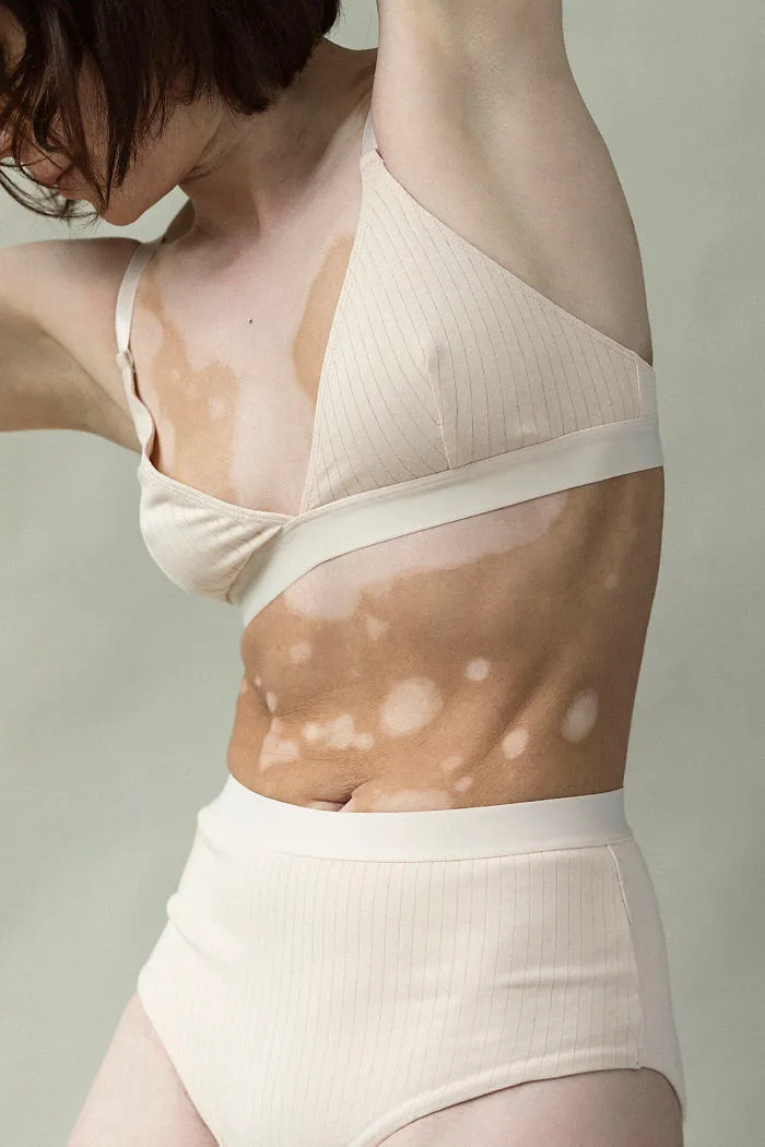 35 Beautiful Women With Vitiligo Shot By A Photographer Who Has The Same Condition