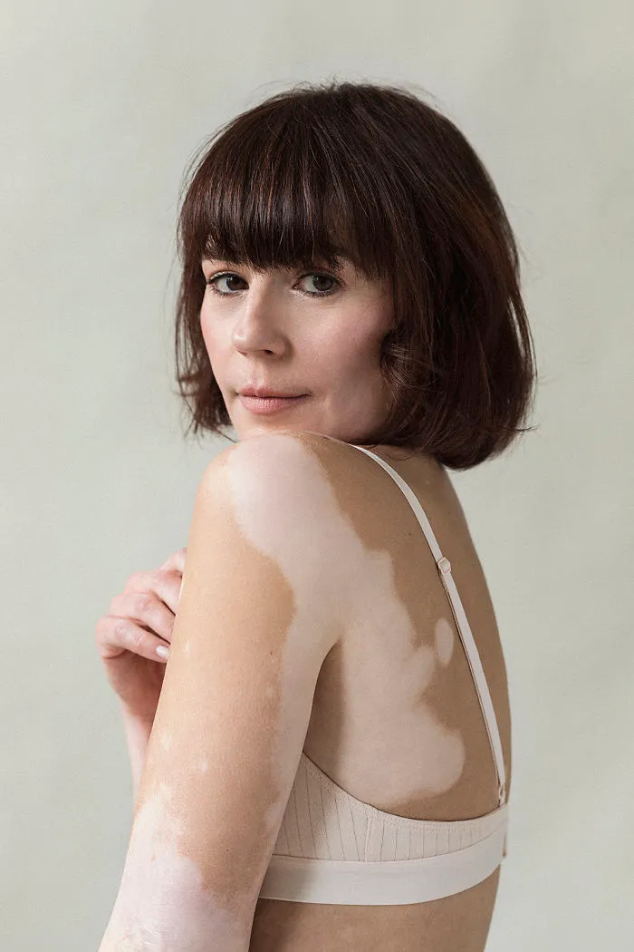 35 Beautiful Women With Vitiligo Shot By A Photographer Who Has The Same Condition