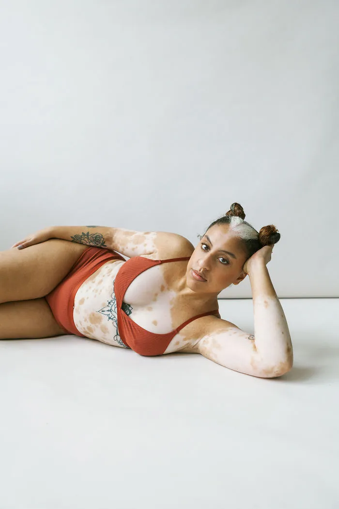 35 Beautiful Women With Vitiligo Shot By A Photographer Who Has The Same Condition