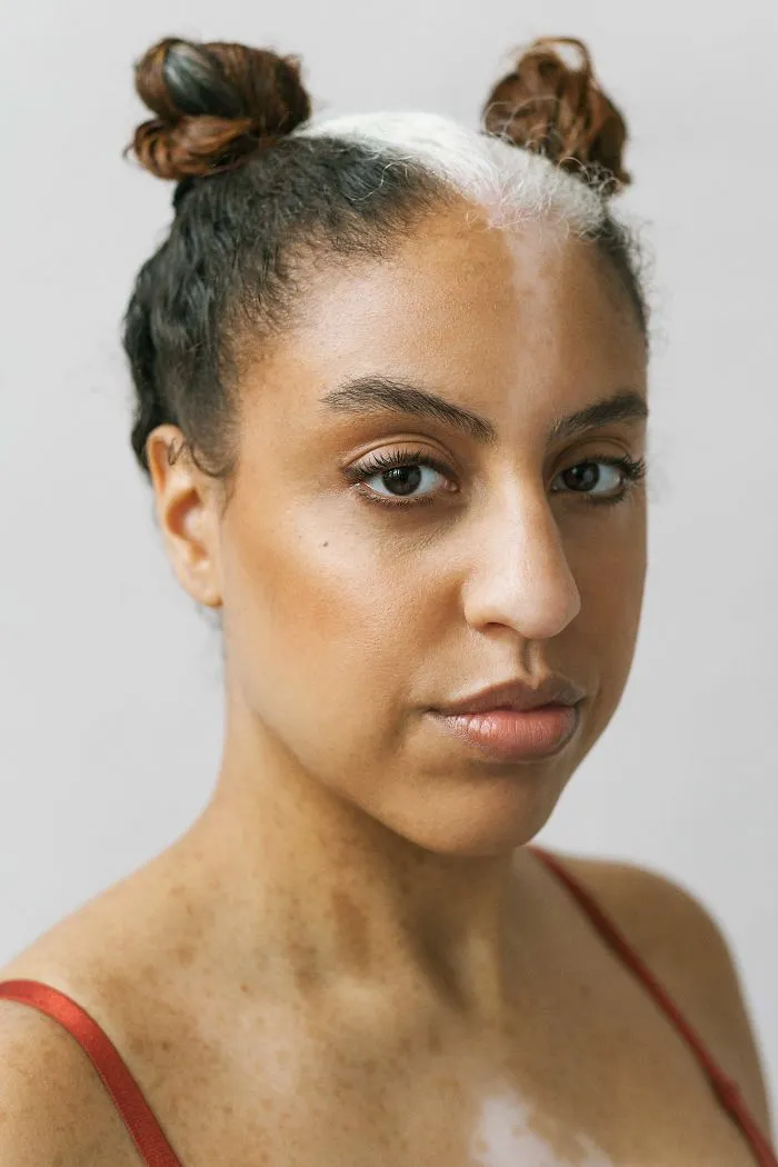 35 Beautiful Women With Vitiligo Shot By A Photographer Who Has The Same Condition