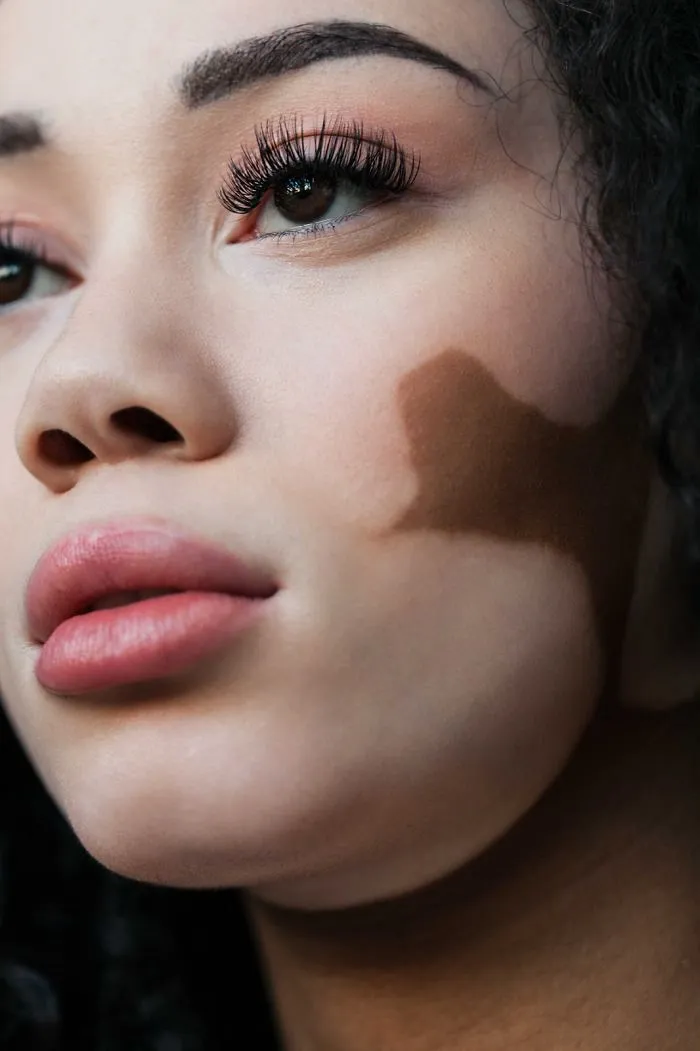 35 Beautiful Women With Vitiligo Shot By A Photographer Who Has The Same Condition