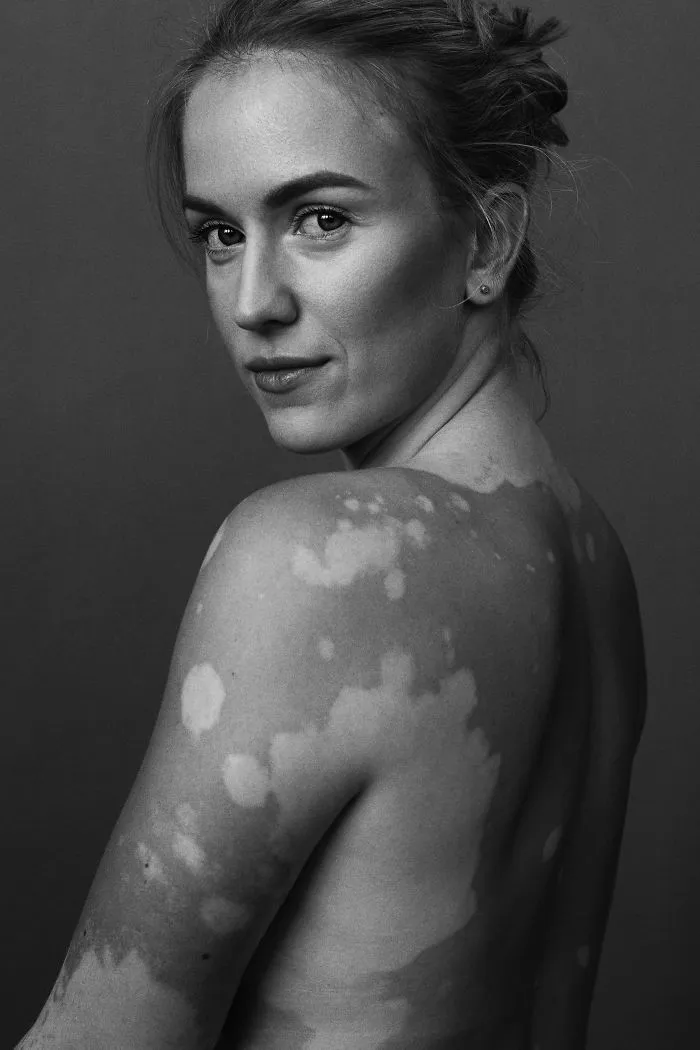 35 Beautiful Women With Vitiligo Shot By A Photographer Who Has The Same Condition