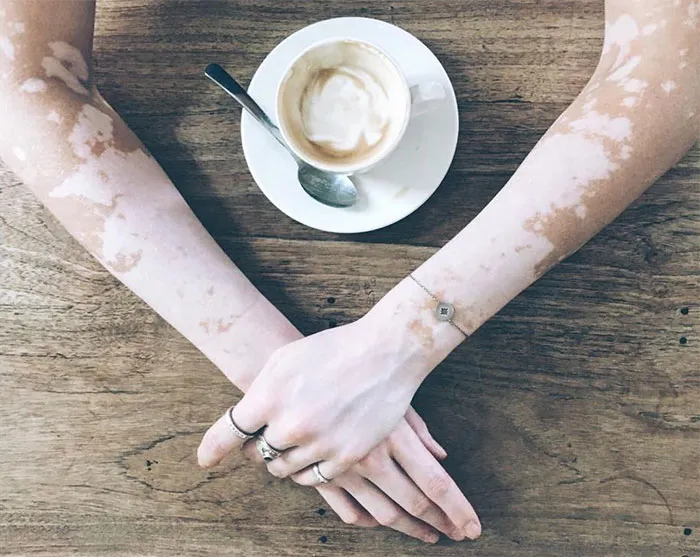 35 Beautiful Women With Vitiligo Shot By A Photographer Who Has The Same Condition