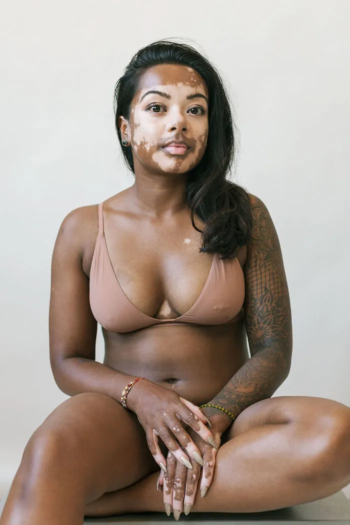 35 Beautiful Women With Vitiligo Shot By A Photographer Who Has The Same Condition