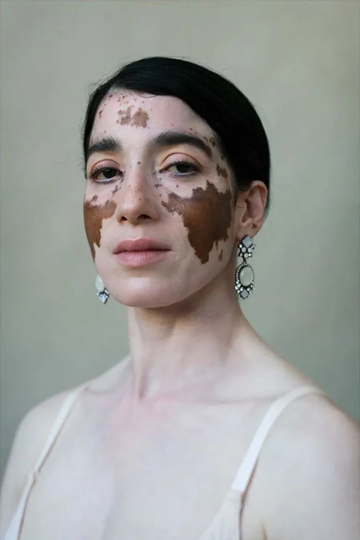 35 Beautiful Women With Vitiligo Shot By A Photographer Who Has The Same Condition
