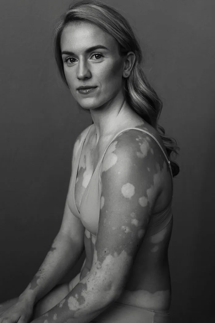 35 Beautiful Women With Vitiligo Shot By A Photographer Who Has The Same Condition