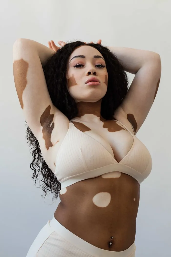 35 Beautiful Women With Vitiligo Shot By A Photographer Who Has The Same Condition