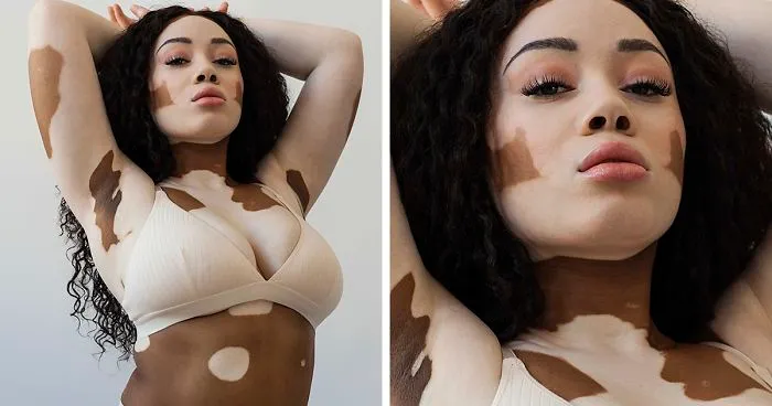 35 Beautiful Women With Vitiligo Shot By A Photographer Who Has The Same Condition