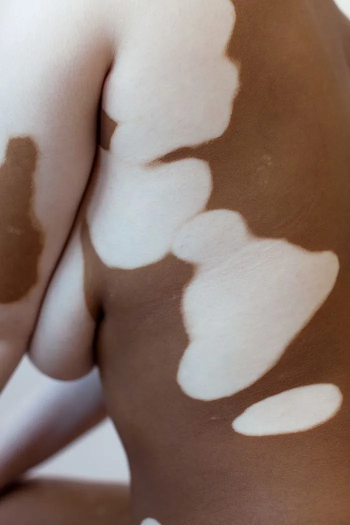 35 Beautiful Women With Vitiligo Shot By A Photographer Who Has The Same Condition