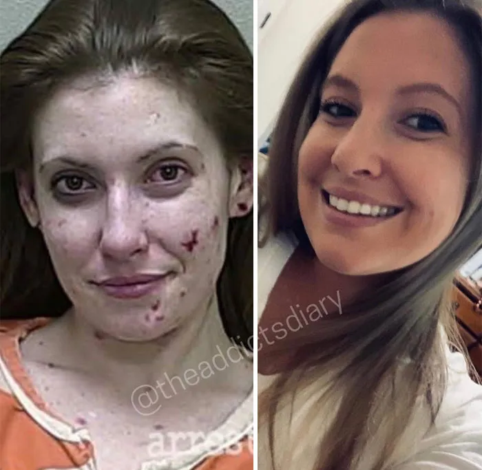 'The Addict's Diary' Showcases Before & After Transformations Of People Who Quit Drugs (30 Stories)