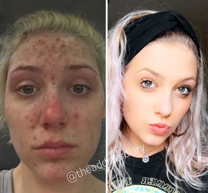 'The Addict's Diary' Showcases Before & After Transformations Of People Who Quit Drugs (30 Stories)
