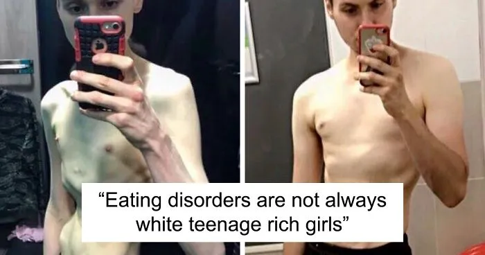 People Have To Explain Guys Can Have Anorexia Too After A Before-And-After Pic Leaves Some In Disbelief
