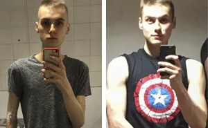 People Have To Explain Guys Can Have Anorexia Too After A Before-And-After Pic Leaves Some In Disbelief